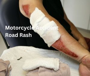 Picture of 3rd degree motorcycle accident road rash.