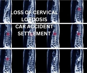 LOSS OF CERVICAL LORDOSIS CAR ACCIDENT SETTLEMENT